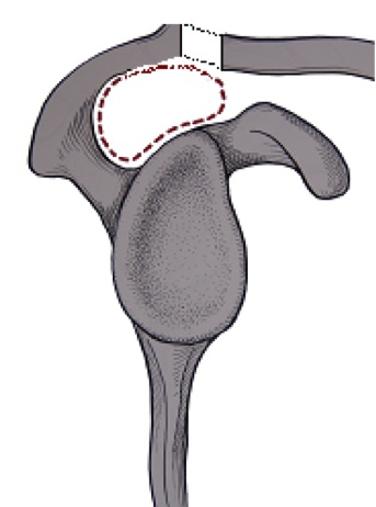 Articulation acromio-claviculaire arthrosique