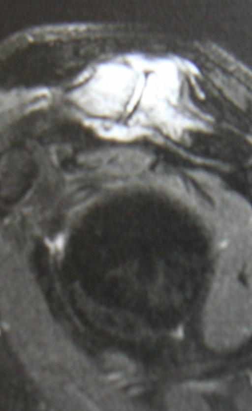 Arthrose acromio-claviculaire
