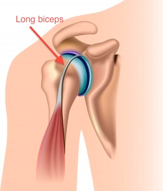 Rupture du tendon long biceps