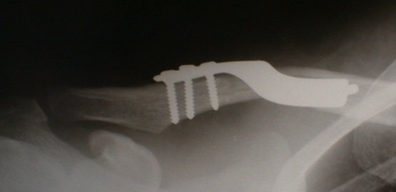 chirurgie Fracture de la clavicule
