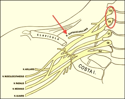 Lésions du nerf Supra scapulaire
