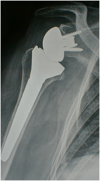 Fractures du col chirurgical