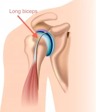 Image long biceps Centre de l'épaule à Bordeaux