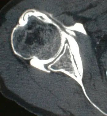 Image rupture du tendon long biceps Centre de l'épaule à Bordeaux