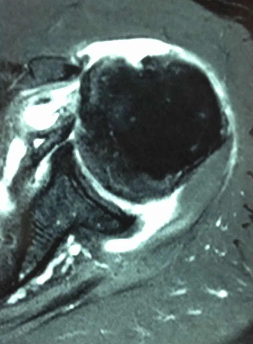 Image rupture du tendon long biceps sub scapulaire Centre de l'épaule à Bordeaux