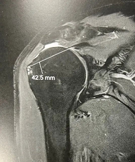 Image rupture retractée de la coiffe Centre de l'épaule à Bordeaux