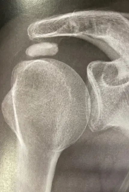 Image tendinopathie calcifiante Centre de l'épaule à Bordeaux