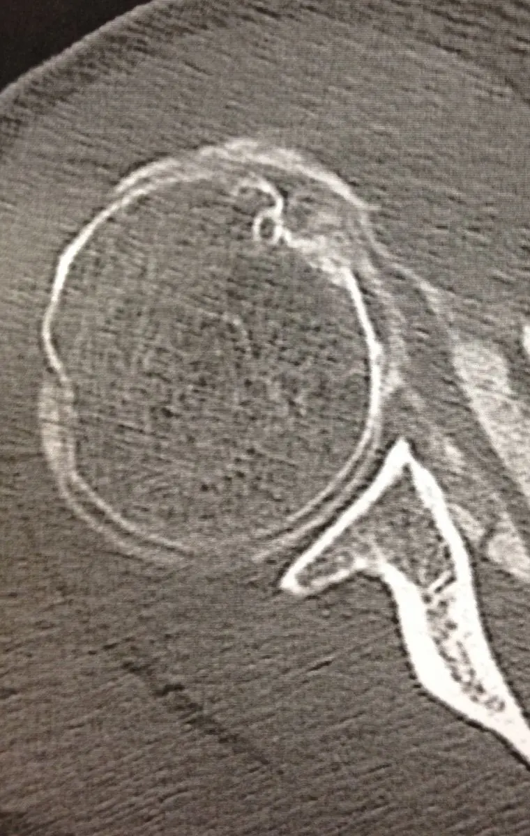 Image rupture du tendon long biceps sub scapulaire Centre de l'épaule à Bordeaux