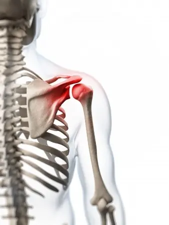 Image arthrose omarthrose et prothèse anatomique Centre de l'épaule à Bordeaux