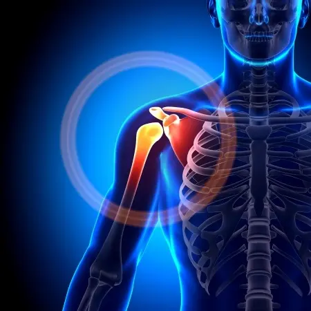 Image arthrose omarthrose et prothèse inverse Centre de l'épaule à Bordeaux