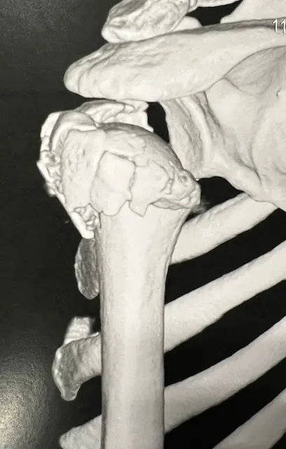 Image fracture complexe esh déplacée cephalotuberositaire Centre de l'épaule à Bordeaux