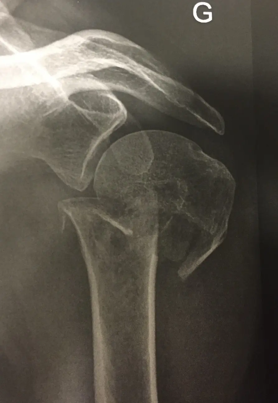 Image fracture humérus proximal déplacée Centre de l'épaule à Bordeaux