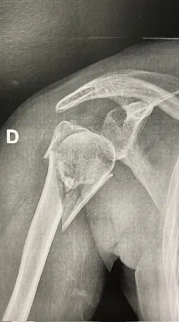 Image fracture humérus proximal déplacée Centre de l'épaule à Bordeaux