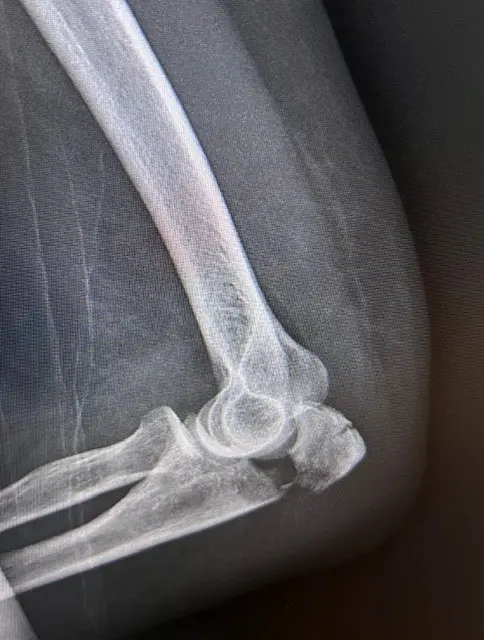 Image fracture olécrane déplacée coude Centre de l'épaule à Bordeaux
