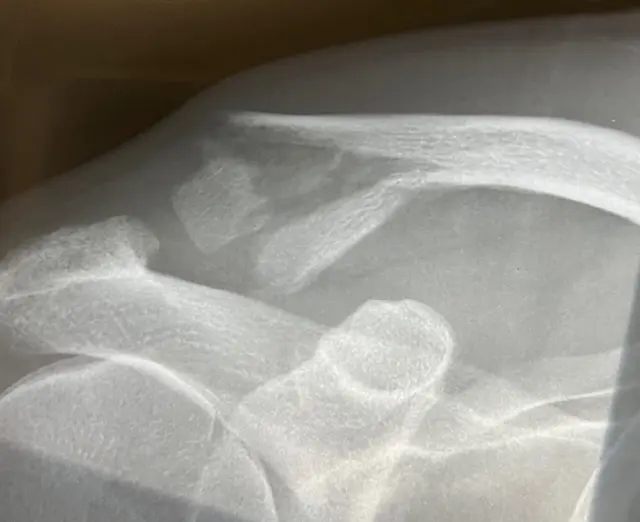 Image fracture un quart déplacée clavicule Centre de l'épaule à Bordeaux