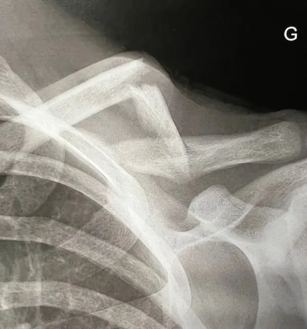 Image fracture un tier moyen déplacée clavicule Centre de l'épaule à Bordeaux