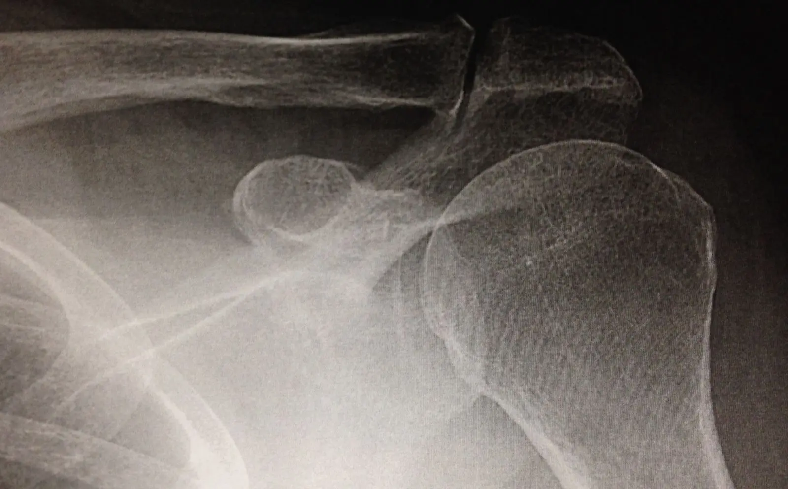 Image ac face rx arthrose Centre de l'épaule à Bordeaux